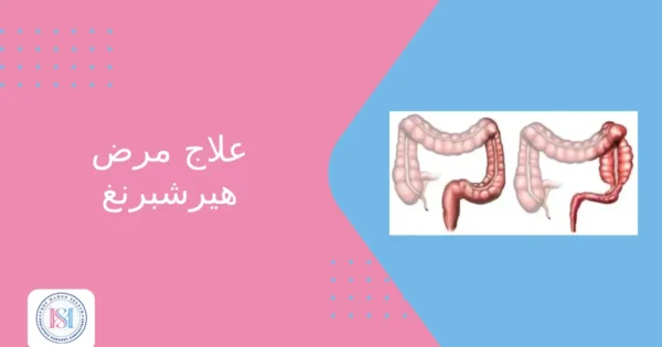 علاج مرض هيرشبرنغ علاج مرض هيرشبرنغ