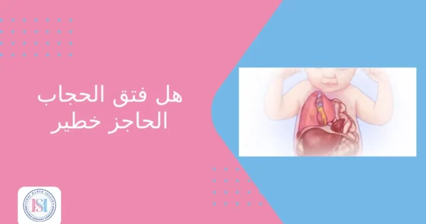 هل فتق الحجاب الحاجز خطير