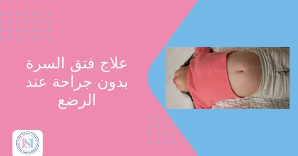 علاج فتق السرة بدون جراحة عند الرضع علاج فتق السرة بدون جراحة عند الرضع